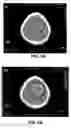 Fig. 05 - Close-proximity range shifting device for proton radiosurgery