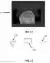 Fig. 09 - Close-proximity range shifting device for proton radiosurgery