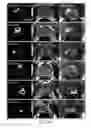Fig. 06 - Automated cancer detection using MRI