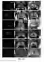 Fig. 07 - Automated cancer detection using MRI