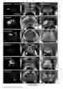 Fig. 08 - Automated cancer detection using MRI