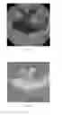 Fig. 04 - System and method for detecting anomalies in an image captured in-vivo using color histogram association
