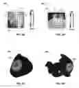 Fig. 03 - Computational localization of fibrillation sources