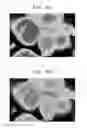 Fig. 10 - Composite positive active material, method of preparing the same, positive electrode including the composite positive active material, and lithium battery including the positive electrode