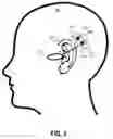 Fig. 04 - Neutralizing the effect of a medical device location