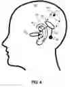 Fig. 05 - Neutralizing the effect of a medical device location