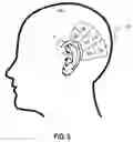 Fig. 06 - Neutralizing the effect of a medical device location