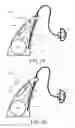 Fig. 04 - Hearing device comprising a feedback detector