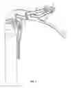Fig. 02 - Intubation device
