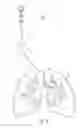 Fig. 06 - LIGHT-BASED ENDOLUMINAL SIZING DEVICE