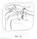 Fig. 08 - Surgical fastening