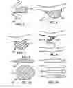 Fig. 05 - Shape memory polymer foams for endovascular therapies