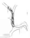 Fig. 197 - VASCULAR TREATMENT DEVICES
