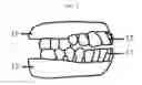 Fig. 06 - POP-A-DENTURE