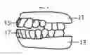 Fig. 07 - POP-A-DENTURE