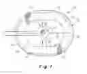 Fig. 02 - Deployment device for a soft tissue repair prosthesis