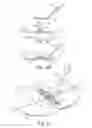 Fig. 09 - Deployment device for a soft tissue repair prosthesis