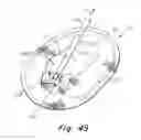 Fig. 28 - Deployment device for a soft tissue repair prosthesis