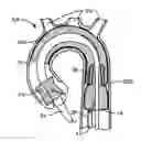 Fig. 01 - Multi-access intraprocedural embolic protection device