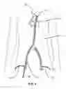 Fig. 05 - Multi-access intraprocedural embolic protection device