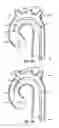 Fig. 06 - Multi-access intraprocedural embolic protection device