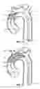 Fig. 07 - Multi-access intraprocedural embolic protection device
