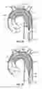 Fig. 08 - Multi-access intraprocedural embolic protection device