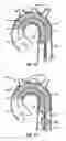 Fig. 09 - Multi-access intraprocedural embolic protection device