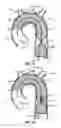 Fig. 10 - Multi-access intraprocedural embolic protection device