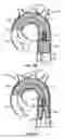 Fig. 12 - Multi-access intraprocedural embolic protection device