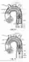 Fig. 16 - Multi-access intraprocedural embolic protection device