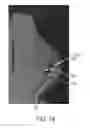 Fig. 20 - IMPLANTABLE DEVICES AND TECHNIQUES FOR ONCOPLASTIC SURGERY
