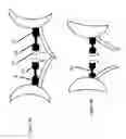Fig. 06 - CARDIAC PROSTHESIS STABILIZATION SYSTEM