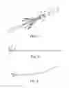 Fig. 02 - Delivery systems and methods of implantation for prosthetic heart valves