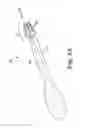 Fig. 04 - Method of implanting a penile prosthetic with a tool having movable jaws