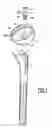 Fig. 02 - Modular humeral prosthesis for an inverted shoulder prosthesis