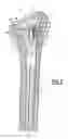 Fig. 04 - Modular humeral prosthesis for an inverted shoulder prosthesis