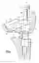 Fig. 05 - Modular humeral prosthesis for an inverted shoulder prosthesis