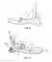 Fig. 06 - Prosthetic device, system and method for increasing vacuum attachment