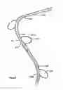 Fig. 05 - Method and apparatus for reducing obesity
