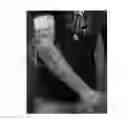 Fig. 01 - Compliant elbow brace configurations