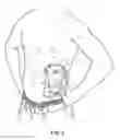 Fig. 03 - Hygienic Protective Barrier for Ostomy Bag