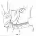 Fig. 04 - Hygienic Protective Barrier for Ostomy Bag