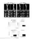 Fig. 05 - Method of treating heterotopic ossification
