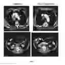Fig. 07 - Treatment of prostate cancer with pap vaccine and PD-1 inhibitor co-therapy