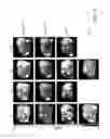 Fig. 19 - Methods of using albumin-CD20 paclitaxel nanoparticle complex compositions for treating cancer
