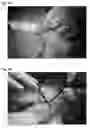 Fig. 03 - ABSORBABLE FIBRIN MICROTHREAD SUTURES FOR REDUCED INFLAMMATION AND SCARRING IN TISSUE LIGATION