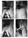 Fig. 04 - ABSORBABLE FIBRIN MICROTHREAD SUTURES FOR REDUCED INFLAMMATION AND SCARRING IN TISSUE LIGATION