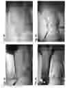 Fig. 05 - ABSORBABLE FIBRIN MICROTHREAD SUTURES FOR REDUCED INFLAMMATION AND SCARRING IN TISSUE LIGATION
