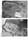 Fig. 06 - ABSORBABLE FIBRIN MICROTHREAD SUTURES FOR REDUCED INFLAMMATION AND SCARRING IN TISSUE LIGATION
